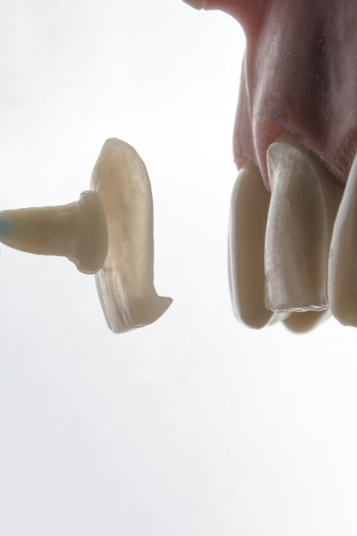 Veneers